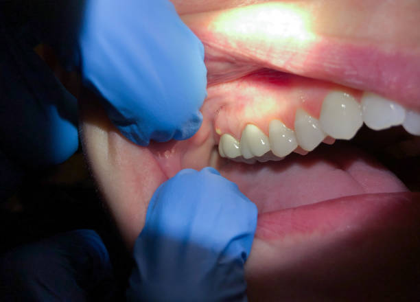 Best Emergency Treatment for Dental Infections or Abscesses in Whitehall, OH